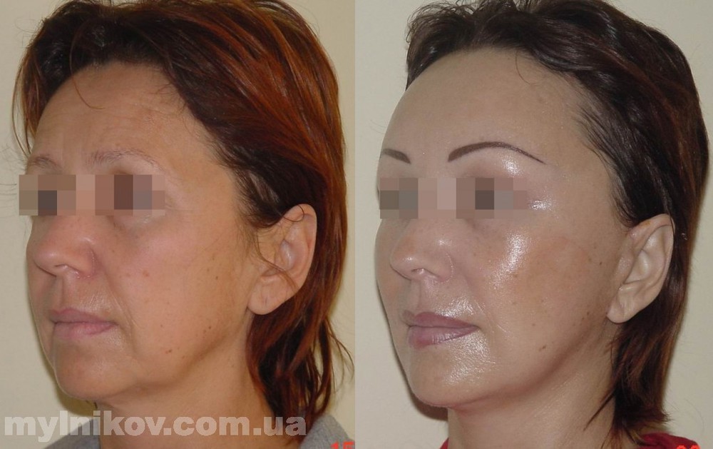 Польза сметаны для диабетиков