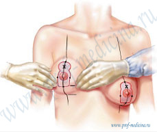 Подготовка к операции по подтяжке груди