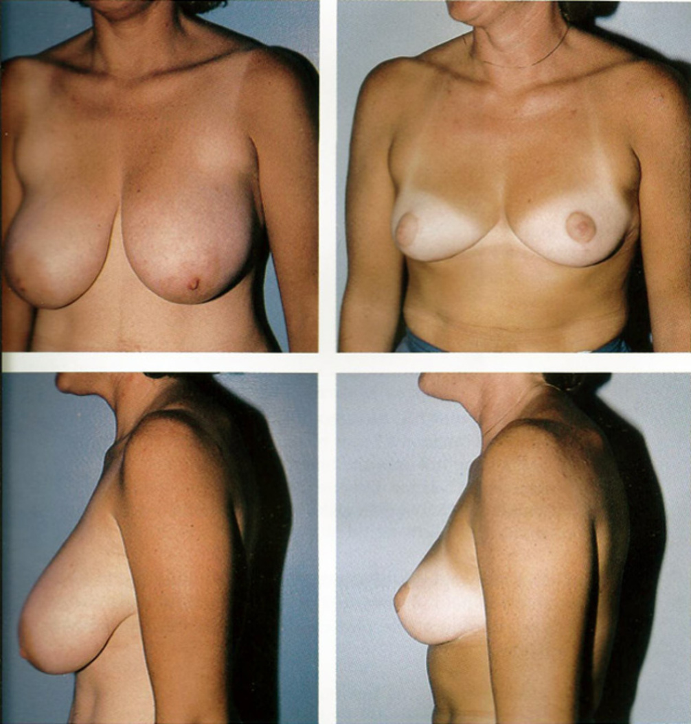 голая грудь после родов фото до и после фото 56