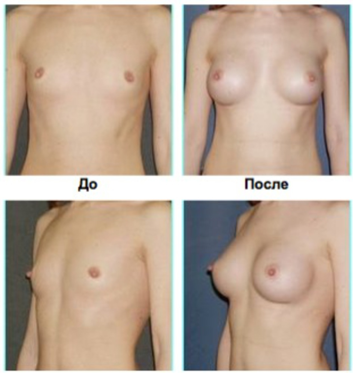 почему у женщин увеличивается грудь фото 79